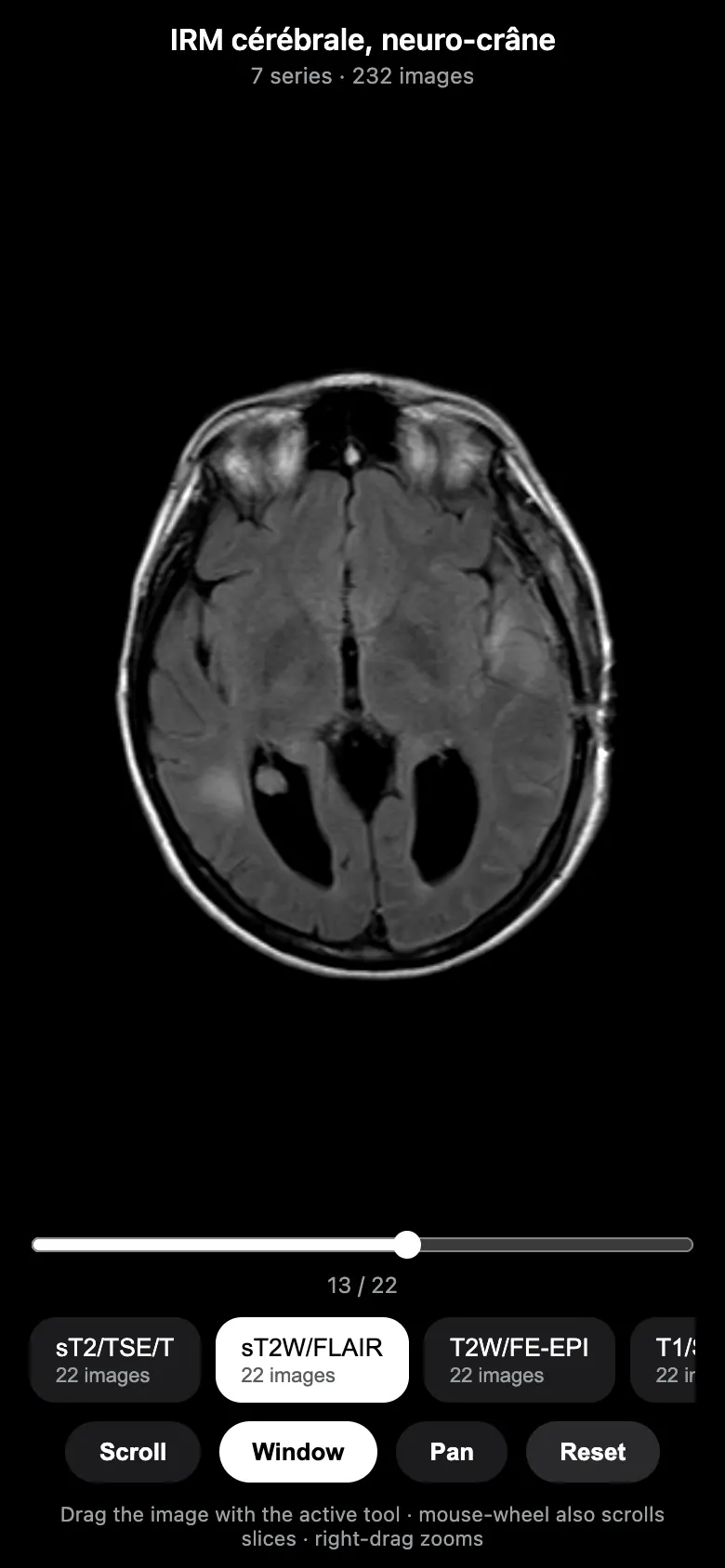 MRI viewer showing a FLAIR series with the Window tool selected