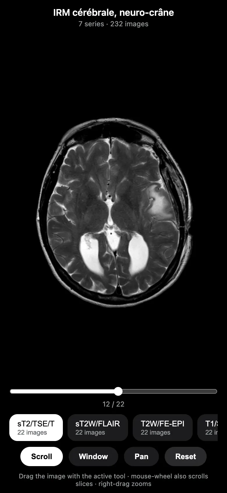 MRI viewer showing an axial brain slice with series chips and a slice scrubber