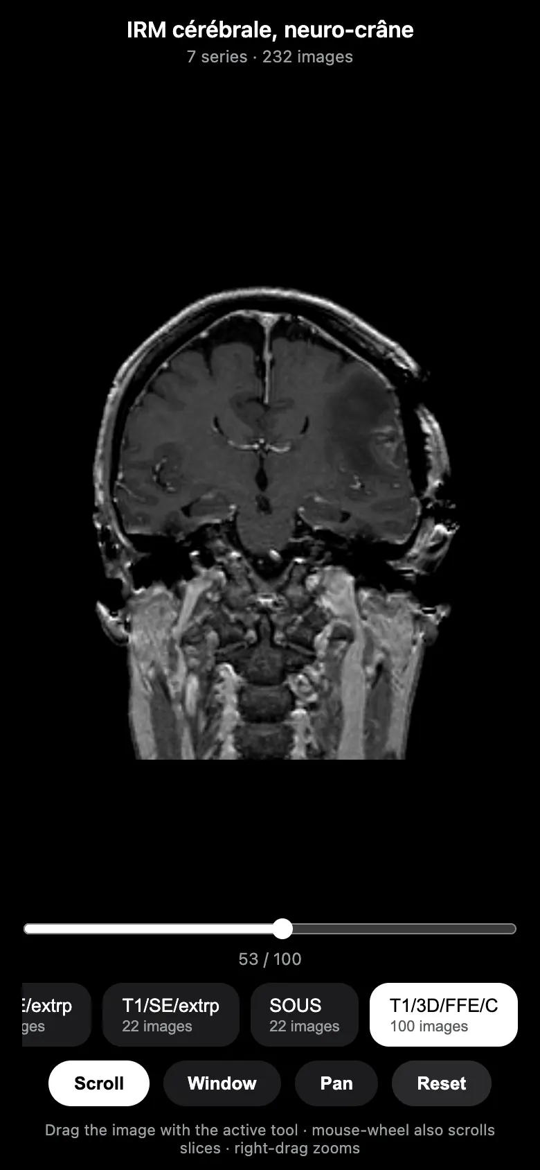MRI viewer on a 100-slice T1 volume, scrolled to the middle of the stack